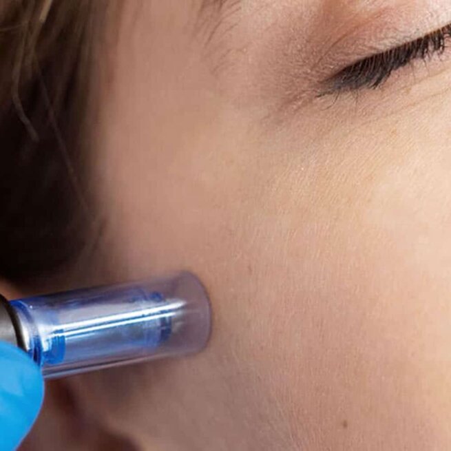 microneedling