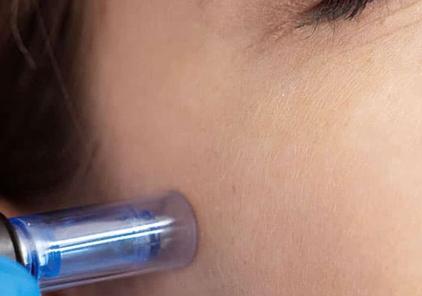 microneedling
