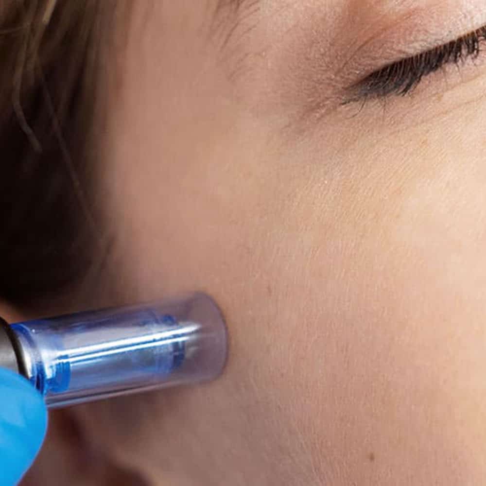 microneedling